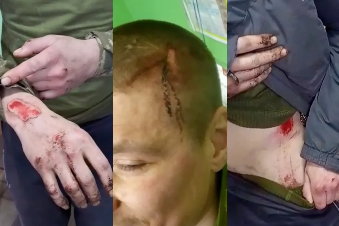 Травмы на теле военнослужащего после пыток в полку «Скеля»